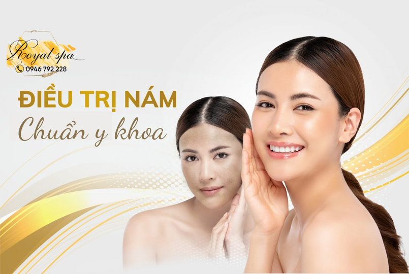 Điều trị nám tại Nam Định
