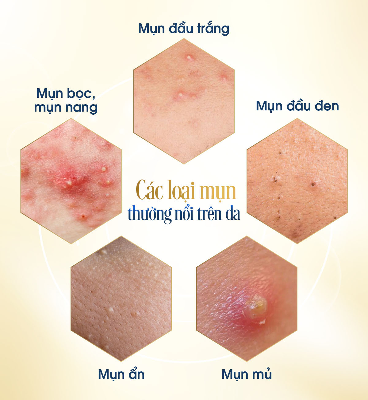 Các loại mụn thường nổi trên da