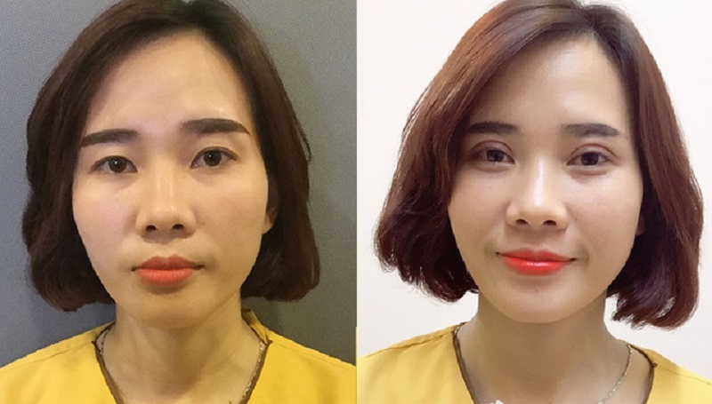 Trước và sau khi cắt mí tại Nam Định của Royal Spa