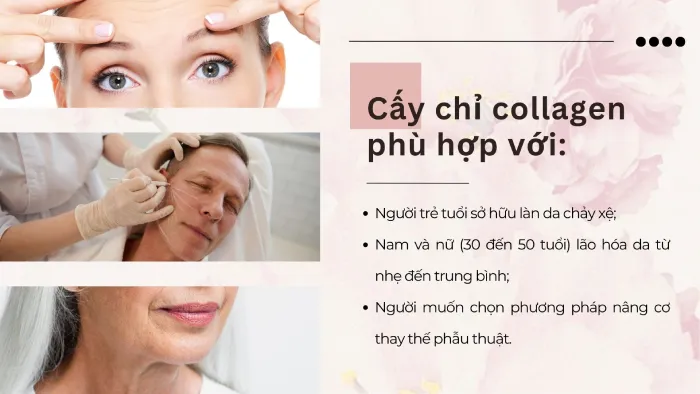 Có nên cấy chỉ collagen tại Nam Định ? Ai phù hợp?