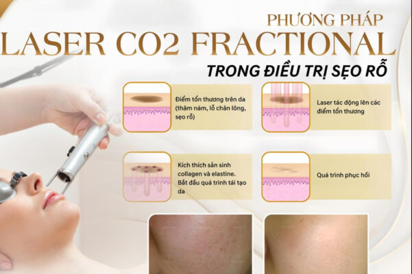 Trị sẹo rỗ tại Nam Định