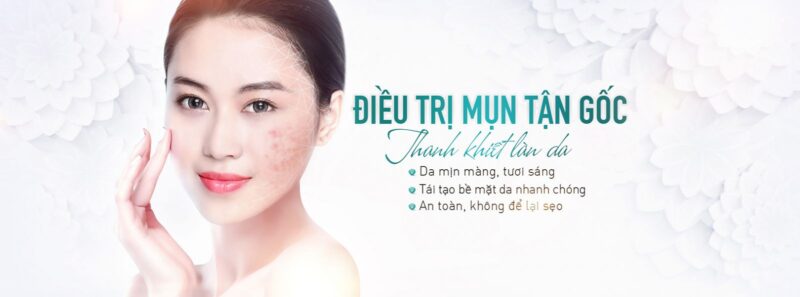 Điều Trị Mụn Tại Royal Spa Nam Định