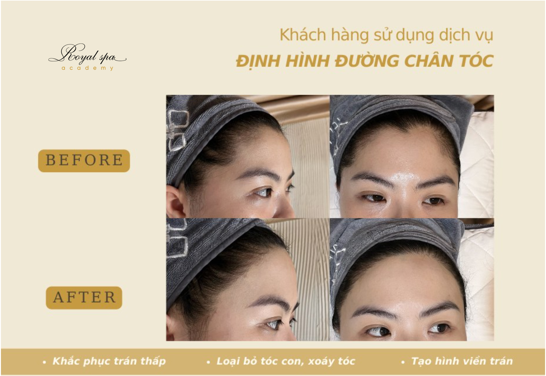 Định Hình Viền Chân Tóc