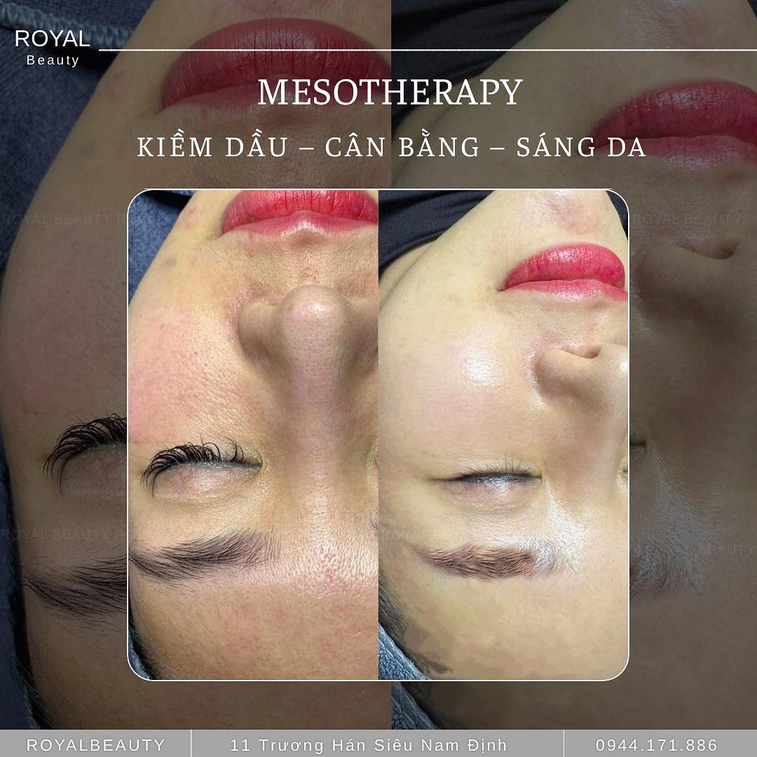 Meso Kiềm Dầu – Giải Pháp Cân Bằng Da Dầu Mụn, Nhạy Cảm Tại Royal Beauty