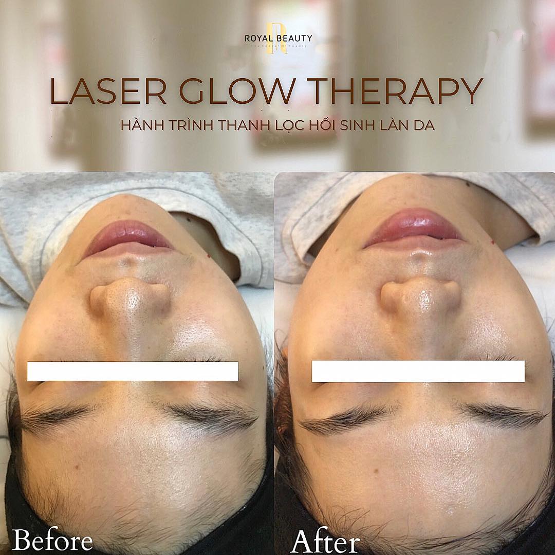 Laser Glow Therapy – Công Nghệ Thanh Lọc Giúp Làn Da “Thở” Và Tỏa Sáng Tự Nhiên | Royal Beauty