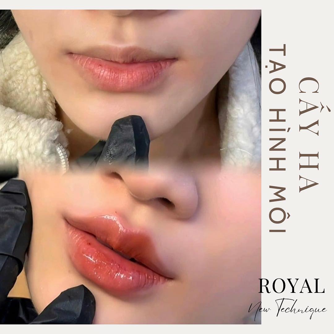 Cấy HA Chỉnh Form Môi – Bí Quyết Tạo Đôi Môi Căng Mọng Tự Nhiên Chỉ Sau 30 Phút