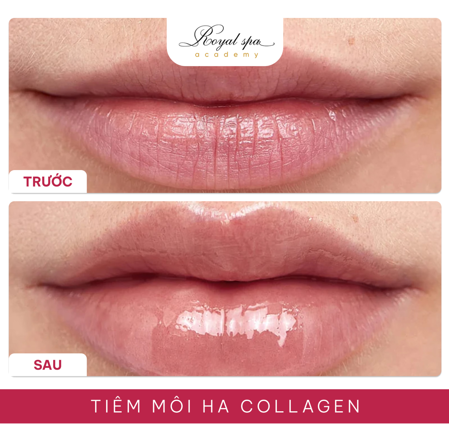 Cấy HA Chỉnh Form Môi – Bí Quyết Tạo Đôi Môi Căng Mọng Tự Nhiên Chỉ Sau 30 Phút