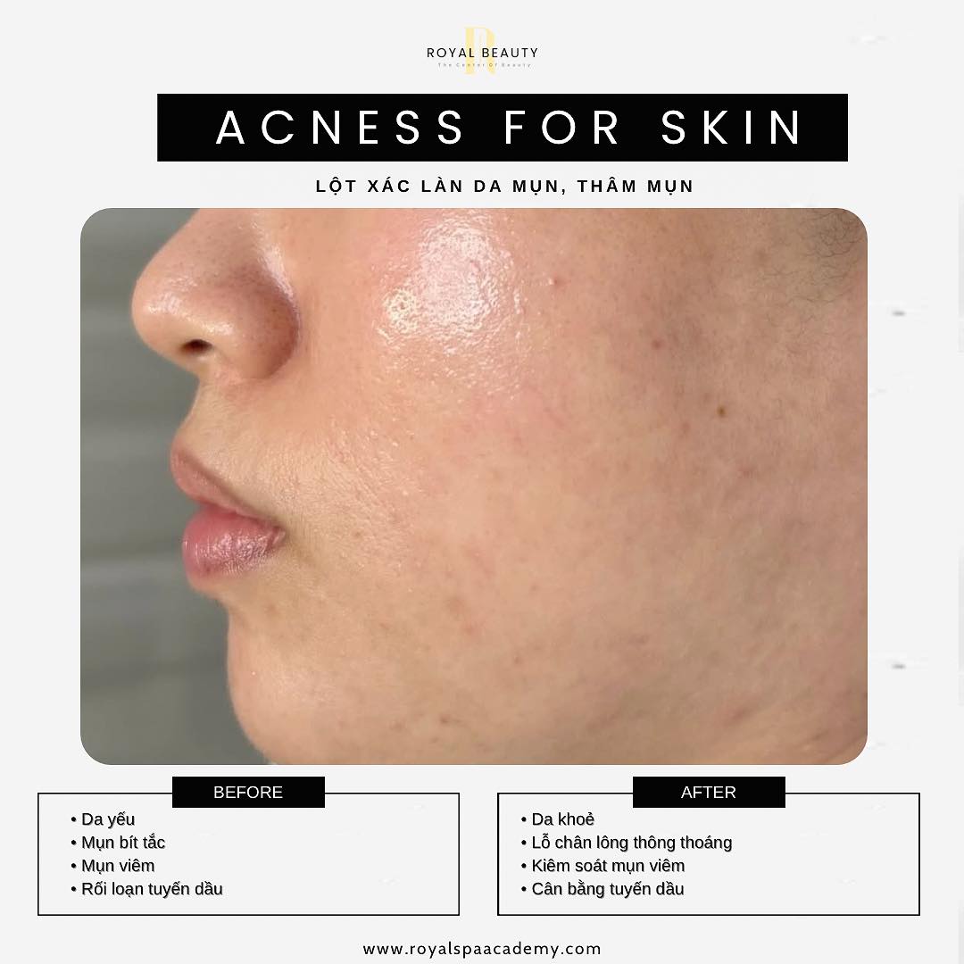 Điều Trị Mụn Nặng Không Phải Dấu Chấm Hết – Royal Beauty: Hành Trình Tái Sinh Làn Da