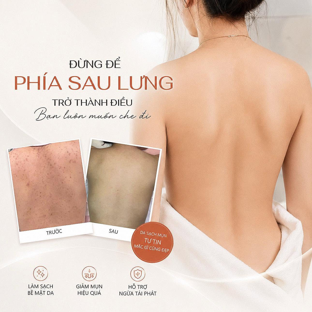 Điều Trị Mụn Lưng Tại Nam Định Uy Tín, Hiệu Quả | ROYAL BEAUTY