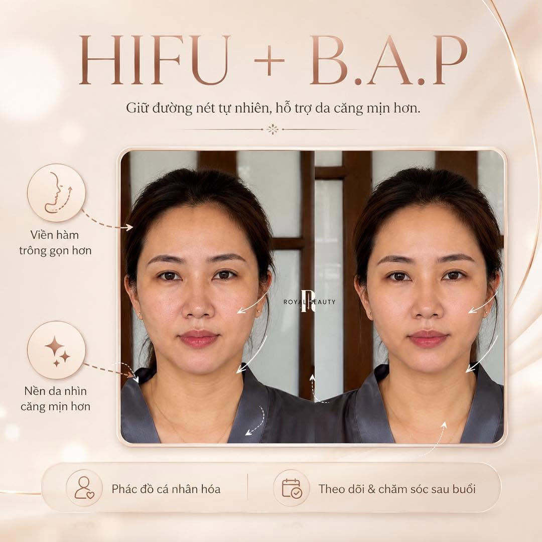 HIFU + B.A.P tại Nam Định | Trẻ Hóa Da Tự Nhiên Cùng Royal Beauty