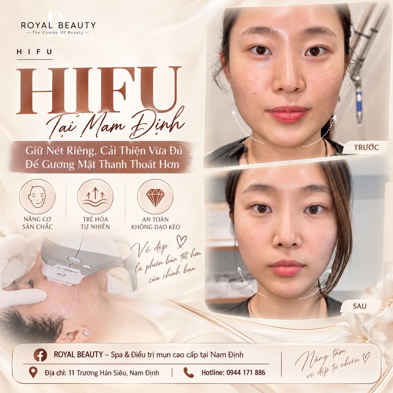 HIFU tại Royal Beauty Nam Định – Cá nhân hóa thay vì chạy theo số lượng