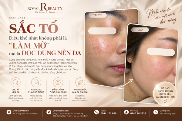 Điều Trị Sắc Tố Tại Nam Định – Đọc Đúng Nền Da Trước Khi Nghĩ Đến Làm Mờ