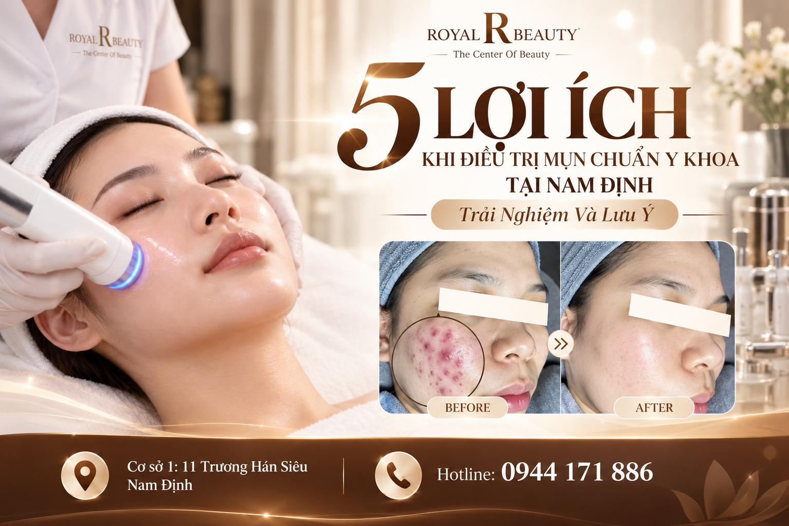 5 Lợi Ích Khi Điều Trị Mụn Chuẩn Y Khoa Tại Nam Định – Trải Nghiệm Và Lưu Ý