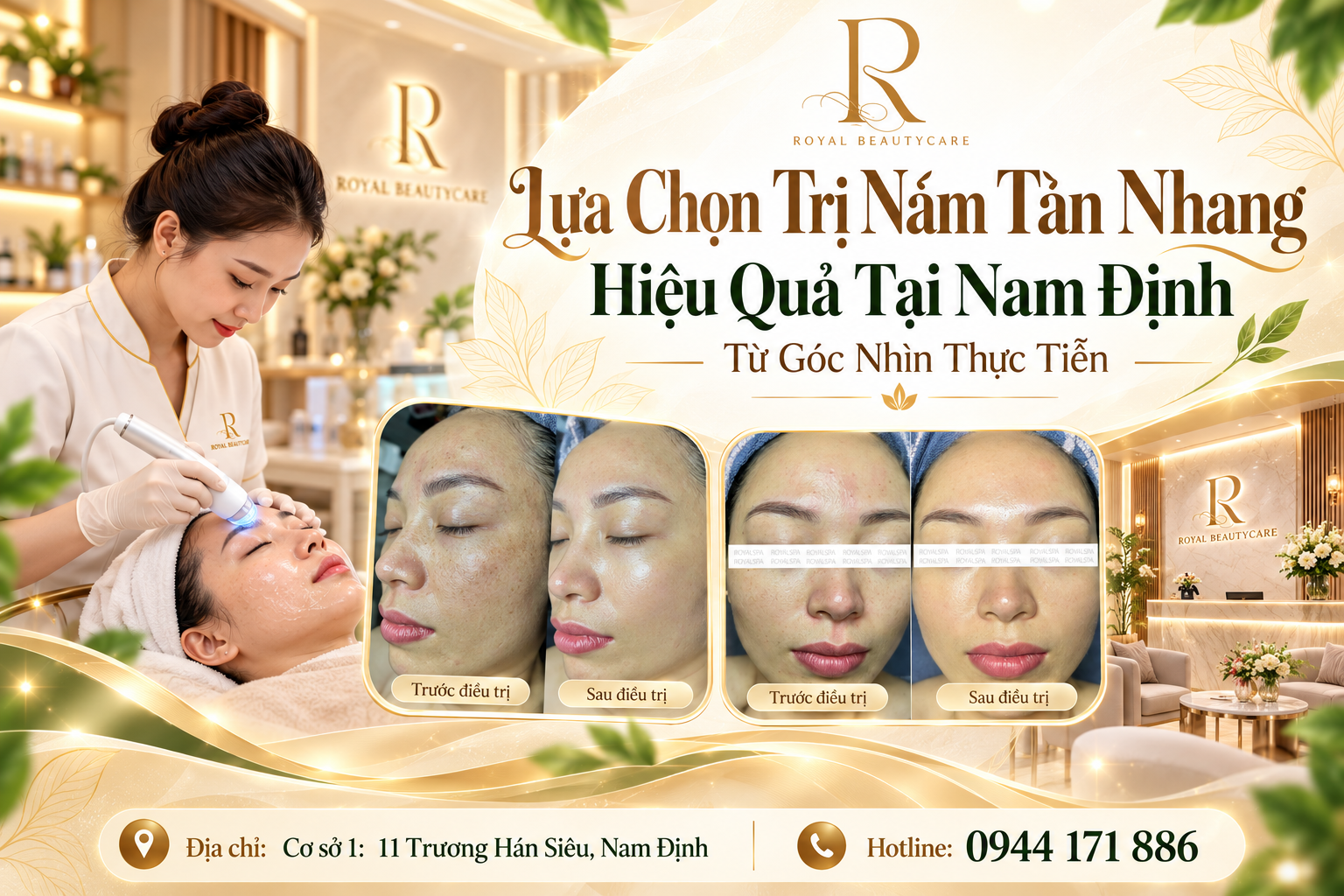 Lựa Chọn Trị Nám Tàn Nhang Hiệu Quả Tại Nam Định Từ Góc Nhìn Thực Tiễn